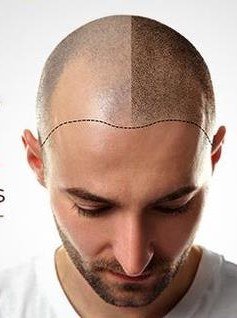 Scalp micropigmentation artistry